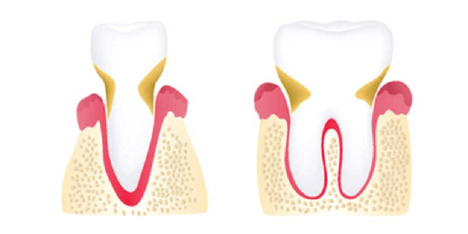 Moderate Periodontitis Stage
