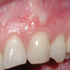 Tooth with covered roots after gum grafting