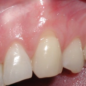 Tooth with roots that are nearly exposed