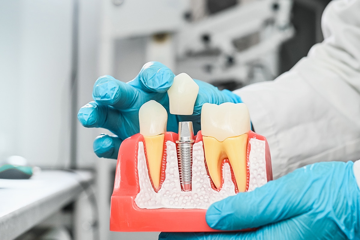 What are all on 4 dental implants benefits cost and what to expect blog